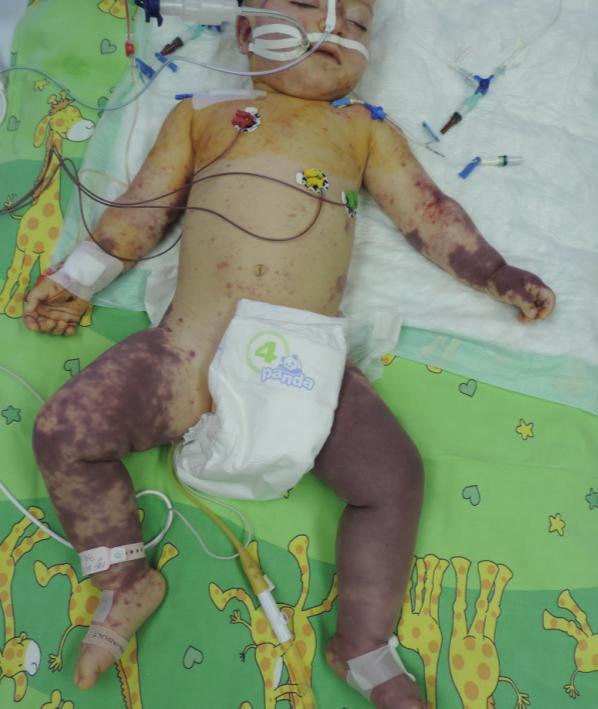 Diagnostika a terapie anamnéza a klinické vyšetření odběry krve (HK, PCR) a likvoru do 30 min podání ATB