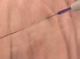 potřebu neustálých výměn skalpelu a standardních elektrochirurgických nožových elektrod během operačního zákroku ACE nožové