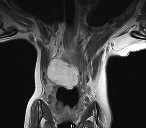 CERVIKÁLNÍ SCHWANNOM V TYREOIDÁLNÍ CHIRURGII vikální schwannom od dalších nádorů neuroektodermového původu, kterými jsou v této oblasti chemodektom (paragangliom, tumor karotického glomu) a