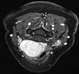 Histologicky jsou schwannomy charakterizovány hypercelulární komponentou palisádových buněk, sešikováním jader a výskytem Verocayových tělísek (Antoni A) a hypocelulární komponentou, tvořenou