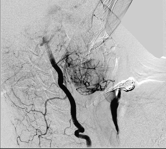 CERVIKÁLNÍ SCHWANNOM V TYREOIDÁLNÍ CHIRURGII Obr. 3a,b: MRI. Expanze 51 31 34 mm, komprimovala a odtlačovala hypofarynx.