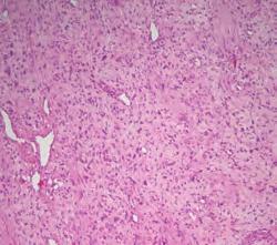 Po exstirpaci nádoru in toto byla v rámci radikality součástí operace totální tyreoidektomie. Pooperační průběh byl klidný, bez komplikací a neurologického deficitu inervace.