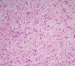 Pooperační histologie štítné žlázy potvrdila makromikrofolikulární koloidní nodózní strumu s ložisky chronické tyroiditidy. Některé uzly byly onkocytárně transformované a inkompletně opouzdřené. Obr.