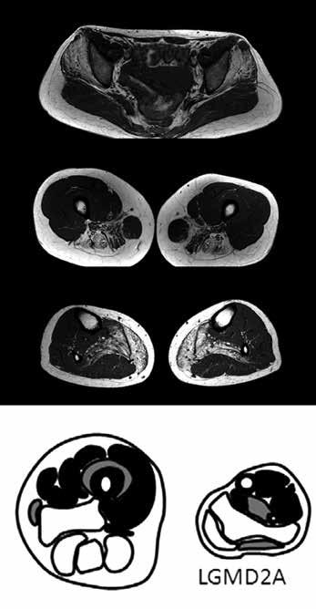 178 Hlavná téma lu různé etiologie. Doporučený postup u pacientů s izolovanou hyperckémií je k dispozici jako EFNS guidelines 2010.