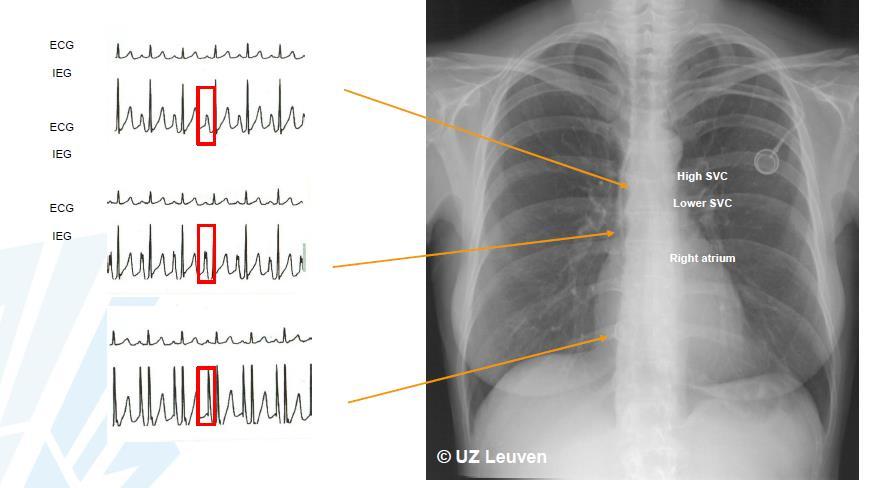 EKG/IKG