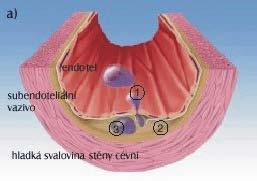 Obr. 2: Endotel při ateroskleróze 1.