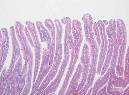 Analogicky s invazivními nádory u Lynchova syndromu (LS) jsou charakteristické ztrátou exprese ně kte rého z mismatch repair (MMR) proteinů.