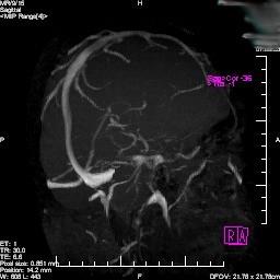 MUDr. Jan Hemza Biomechanická problematika tenkostěnných žil mozku 19 Obrázek 2.