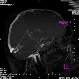 Zadní odtéká do sinus occipitalis, z přední jdou větvičky podél nervů, zejména n. nervus hypoglossus do žil v canalis hypoglossi.