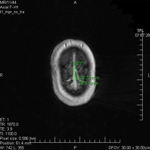 8 Měření v obraze MRI geometrie přemosťujících žil