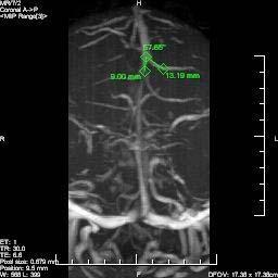 MUDr. Jan Hemza Biomechanická problematika tenkostěnných žil mozku 59 Obrázek 6.