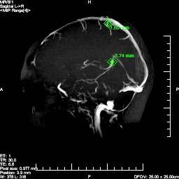přemosťujících žil mozku byla měřena na MRI zobrazeních žilního systému mozku.