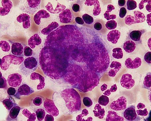Trombopoéza megakaryoblast 15-45 µm, ovoidní jádro s jadérky,