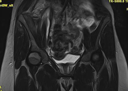 přes 10cm, tekutina pak přechází kolem horního