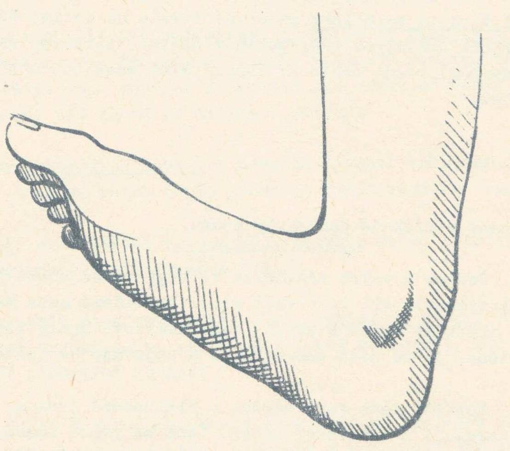 Hákovitá noha (pes calcaneovalgus) (Obrázek 13) Kubát (1987) o hákovité noze zmiňuje, že se nejčastěji vyskytuje jako vrozená vada, ale může vzniknout i během růstu po infekčních onemocněních,