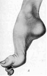 oha svislá (pes equinus) Řihovský (1975) uvádí, že při této deformaci, která je zapříčiněna trvalým nošením obuvi s vysokým podpatkem není možné došlápnout na patu.