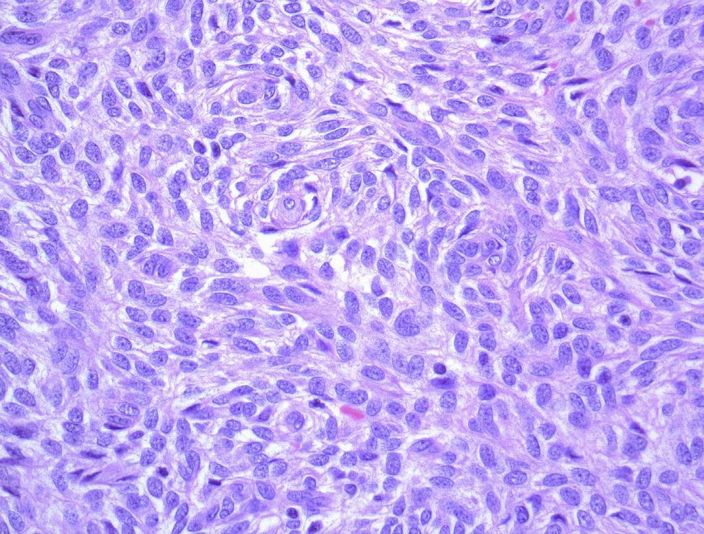 histologicky napodobují endometriální stroma monomorfní oválné až