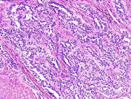 Tumor dělohy napodobující ovariální sex-cord tumor (UTROSCT: uterine tumor resembling ovarian sex cord tumor) sex-cord diferenciace je predominantní