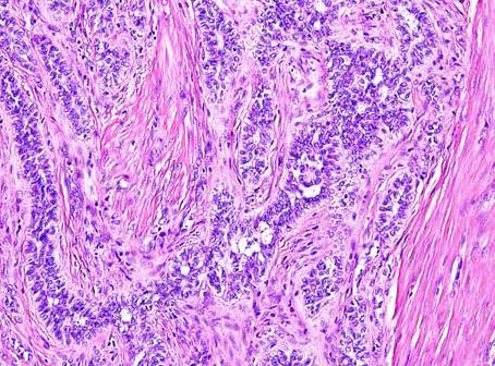 složky napodobující proliferační endometrium AE1/3+, calretinin+, WT-1+, ER+, PR+ CD10 +/-, EMA+/-,inhibin +/-, FOXL2 +/-, SF-1 +/- desmin +/-, SMA +/-,
