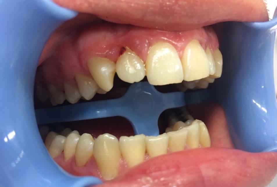 Obrázek 3: Plakem podmíněná gingivitis [zdroj: vlastní] 4.