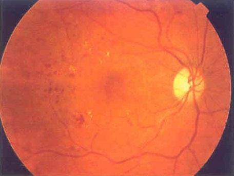 U diabetické retinopatie rozlišujeme dvě fáze, podle závažnosti intraretinálních neovaskularizací, neproliferativní a proliferativní.