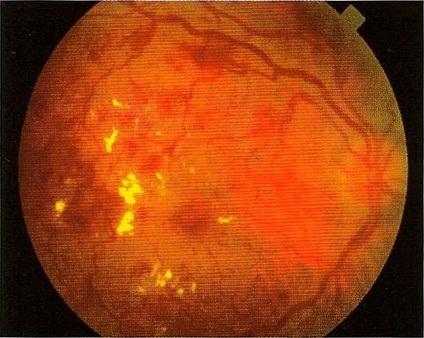 Obr. 7 Proliferativní retinopatie Klasifikace Oftalmologický obraz Mírně a středně mikroaneurysmata neproliferativní retinopatie krvácení vatovitá ložiska tvrdé exudáty otok korálkový vzhled žil