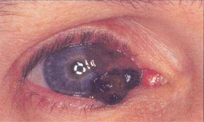 Sítnice bývá postižena i dalšími infekcemi jako je toxoplazmóza, kandidóza, virem herpes simplex, herpes zoster a mykobakteriemi.