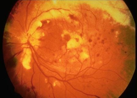 Infekce mohou dále způsobit obrny okohybných nervů, abnormality zornicových reakcí, defekty v zorném poli a neuropatii zrakového nervu. [3,4,6] Obr. 12 Kaposiho sarkom Obr.
