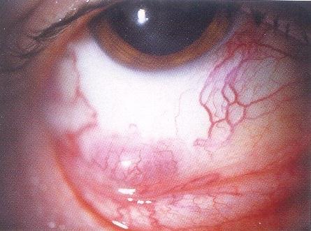 Obr. 14 Lymfom spojivky 10.3 Paraneoplastické syndromy Paraneoplastické syndromy jsou vzácná onemocnění, která jsou vyvolána systémovými malignitami.