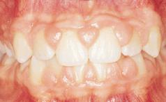 Základem léčby je výborná dentální hygiena s odstraněním dráždivých kofaktorů. Důležité je, aby pacient po dohodě s ošetřujícím lékařem změnil medikaci.