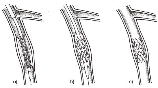 Obrázek 1.1.4.1-3 Implantace intrakoronárního stentu [6, str. 33