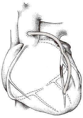 Obrázek 1.1.4.1-5 Revaskularizace myokardu dvěma sekvenčními aortokoronámími bypassy.