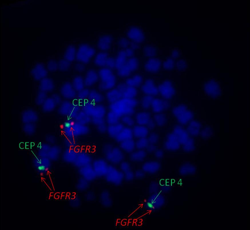 Obrázek č. 33: Potvrzení trizomie chromozómu 4. CEP 4 označení centromery 4, FGFR3 označení genu FGFR3 U pacienta č. 5 byl opět prokázán variantní nález.