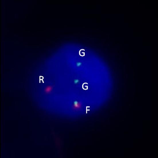 Obrázek č. 39: Ukázka obrazu pro translokaci t(4;14) (1F1R2G) v interfázním jádru. F fúze, R červený signál, G zelený signál Obrázek č.