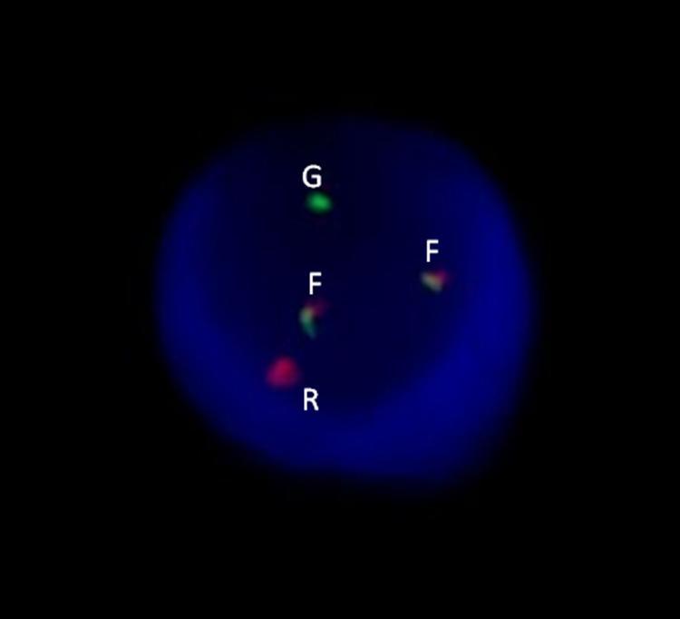 Obrázek č. 27: Běžný obraz pro translokaci t(4;14) na chromozómech a v interfázním jádru.