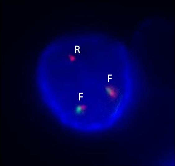 Obrázek č. 30: Ukázka obrazu pro translokaci t(4;14) (2F1R) v interfázním jádru. F fúze, R červený signál U pacienta č.