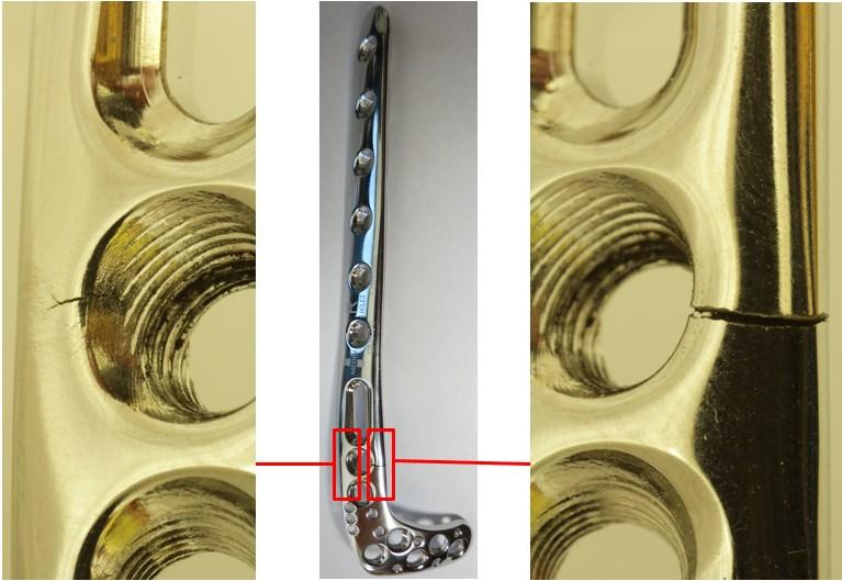 6.4.2 Dynamické zatížení anterolaterální dlahy V první fází je anterolaterální dlaha zatěžována cyklickým zatěžováním tlakovou silou F S1a = 250 N při požadovaném počtu cyklů 500 000.