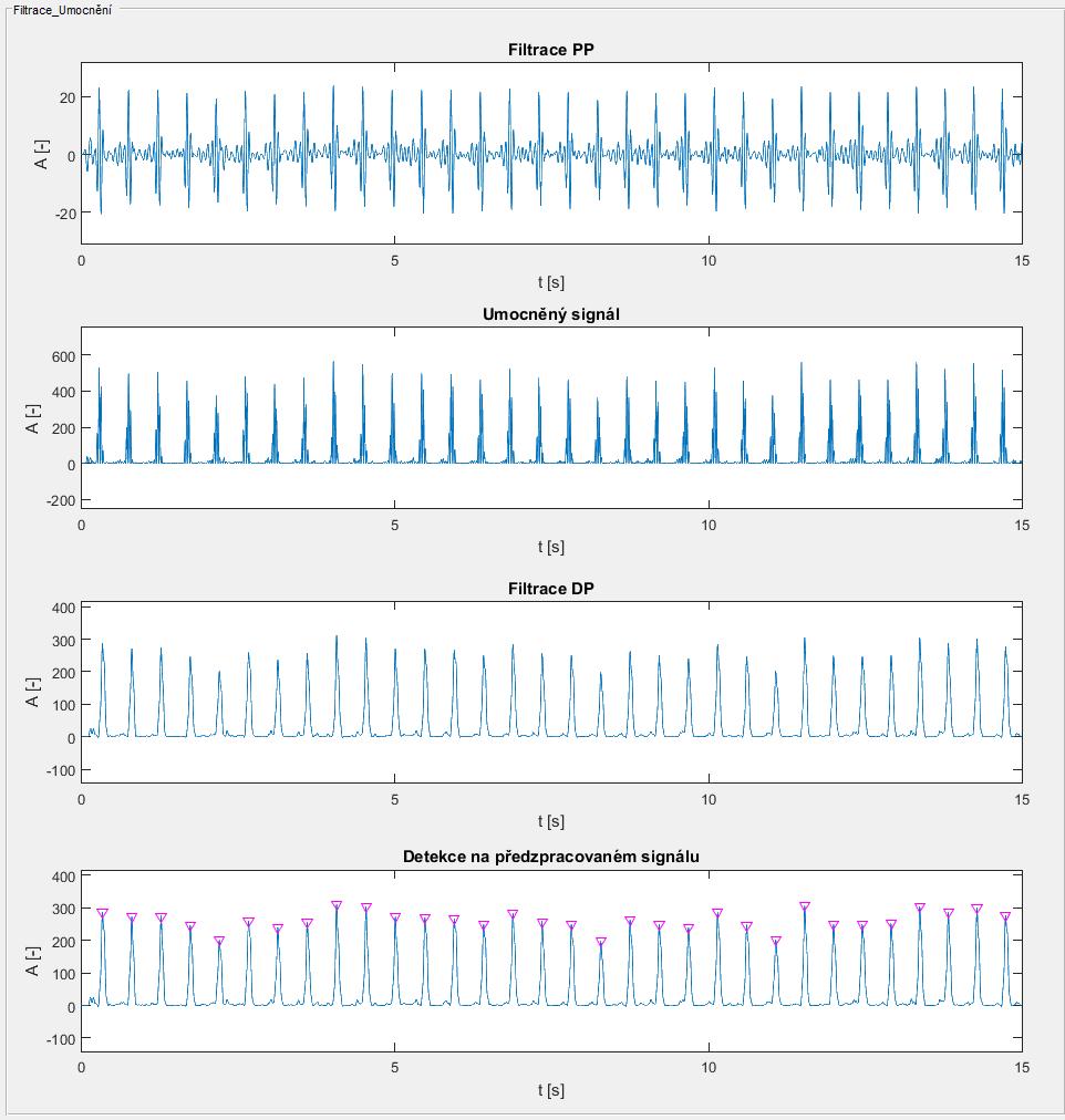 Obrázek 23: GUI Předzpracování signálu Třetí část GUI je zaměřena na prezentaci výsledků detekce. V této části je opět zobrazen úsek vstupního signálu, ale již s detekovanými QRS komplexy.