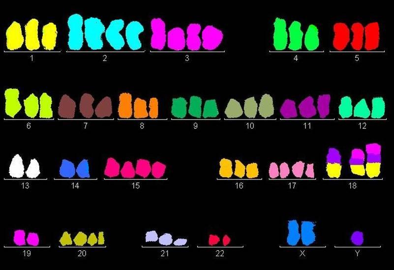 Tabulka 8: Přehled jednoduchých změn v karyotypu Typ změny Počet pacientů Ztráta chromosomu Y u muţů 6 Delece 6q 1 Delece 1q 1 22ps+ 1 Add(1p) 1 1 2 marker chromosomy 1 Obrázek 9: Ukázka výsledku