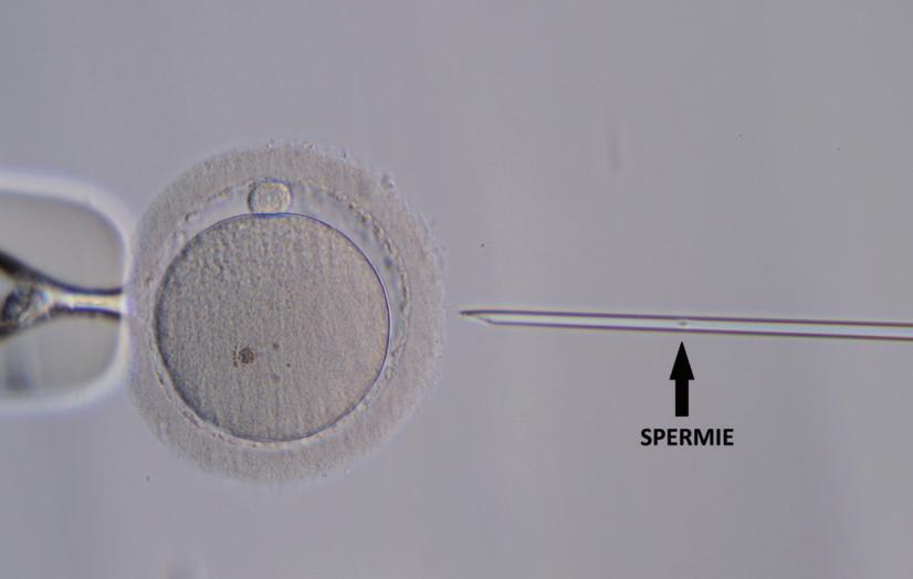 chirurgickým odběrem z varlete nebo nadvarlete, plánované preimplantační genetické testování vzniklých embryích (PGT) a nebo v pří padě selhání oplození vajíček v