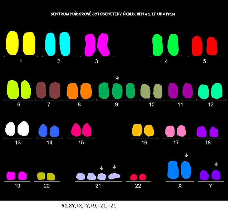 Obrázek 6: Hyperdiploidie. Výsledek analýzy metodou mfish. (Převzato z databáze Centra nádorové cytogenetiky VFN a 1.