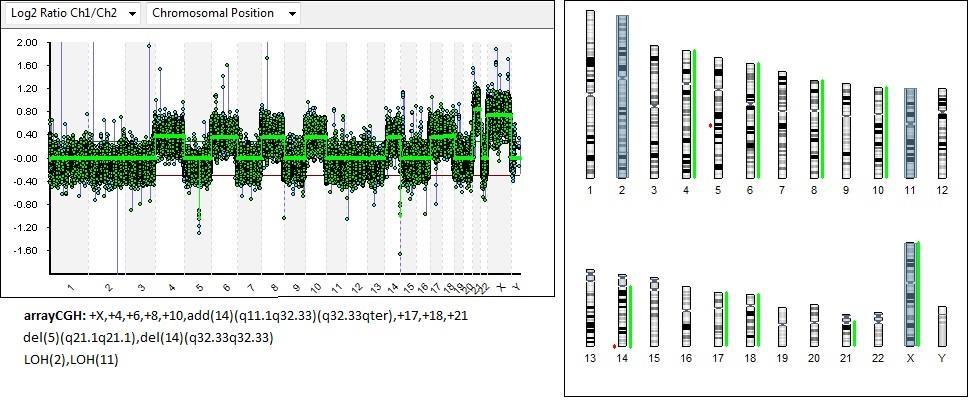 1 a derivovaný chromozom, který vznikl nebalancovanou translokací mezi chromozomy 6 a X. (Převzato z databáze Centra nádorové cytogenetiky VFN a 1.