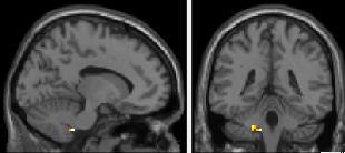 (uncorr.) thalamus (uncorr.