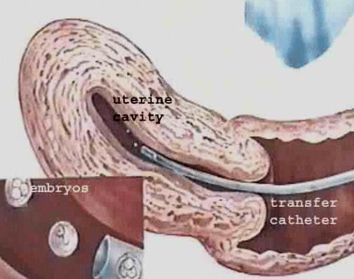 Příloha 9 Přenos embrya (embryotransfer ET) Zdroj: