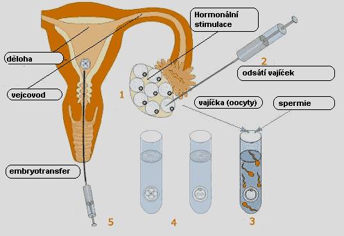 Příloha 2 Metoda IVF Zdroj: http://www.