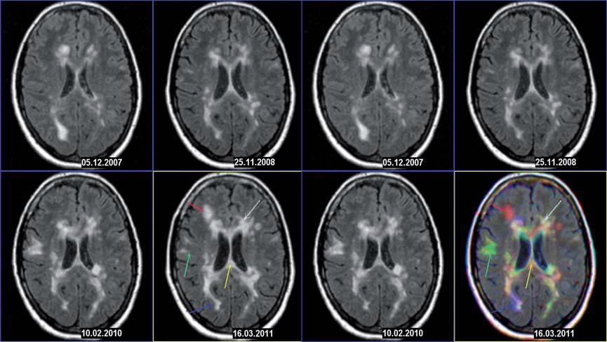 hematoencephalickou bariéru). Díky této metodě byla prokázána 5x až 10x vyšší četnost nových zánětlivých ložisek než klinických atak.
