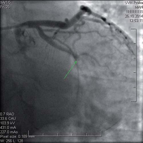 M. Hajšl et al. 723 dobrá apozice stentu in-stent trombóza Obr. 3 Ramus marginalis sinister časná in-stent trombóza Obr.