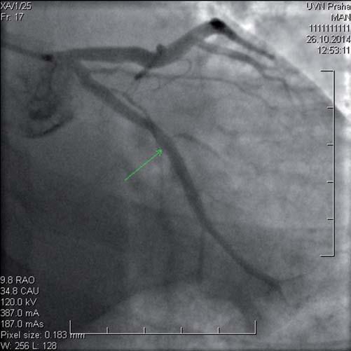 4) doplnili intravaskulární ultrazvuk (IVUS) ošetřeného úseku s vyloučením komplikace či špatné apozice stentu (obr. 5).