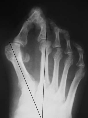 Příloha 8 RTG snímek hallux valgus Zdroj: POPELKA, Stanislav et al., 2011.