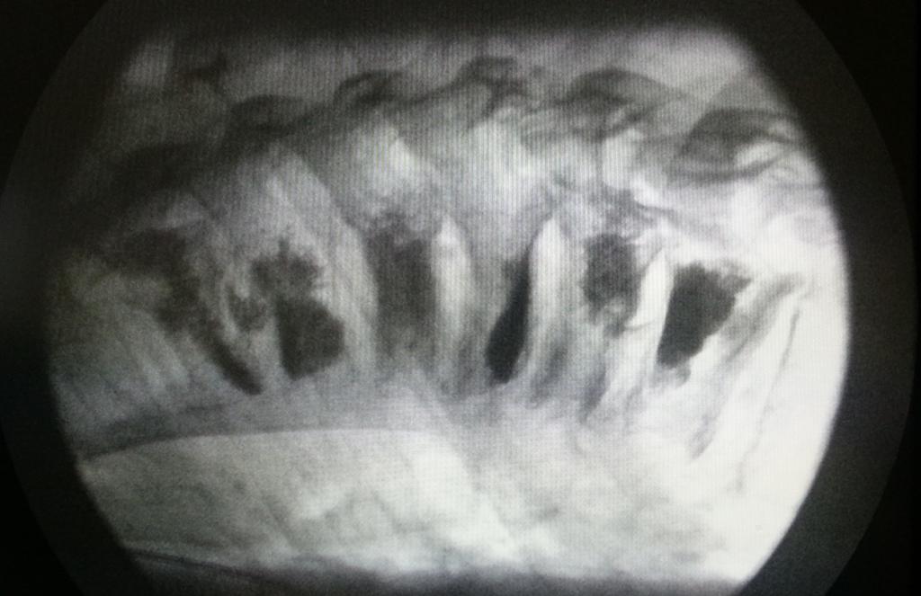 Obr. 16 peroperační skiaskopie (finální snímek po vytažení VP kanyl) vertebroplastiky